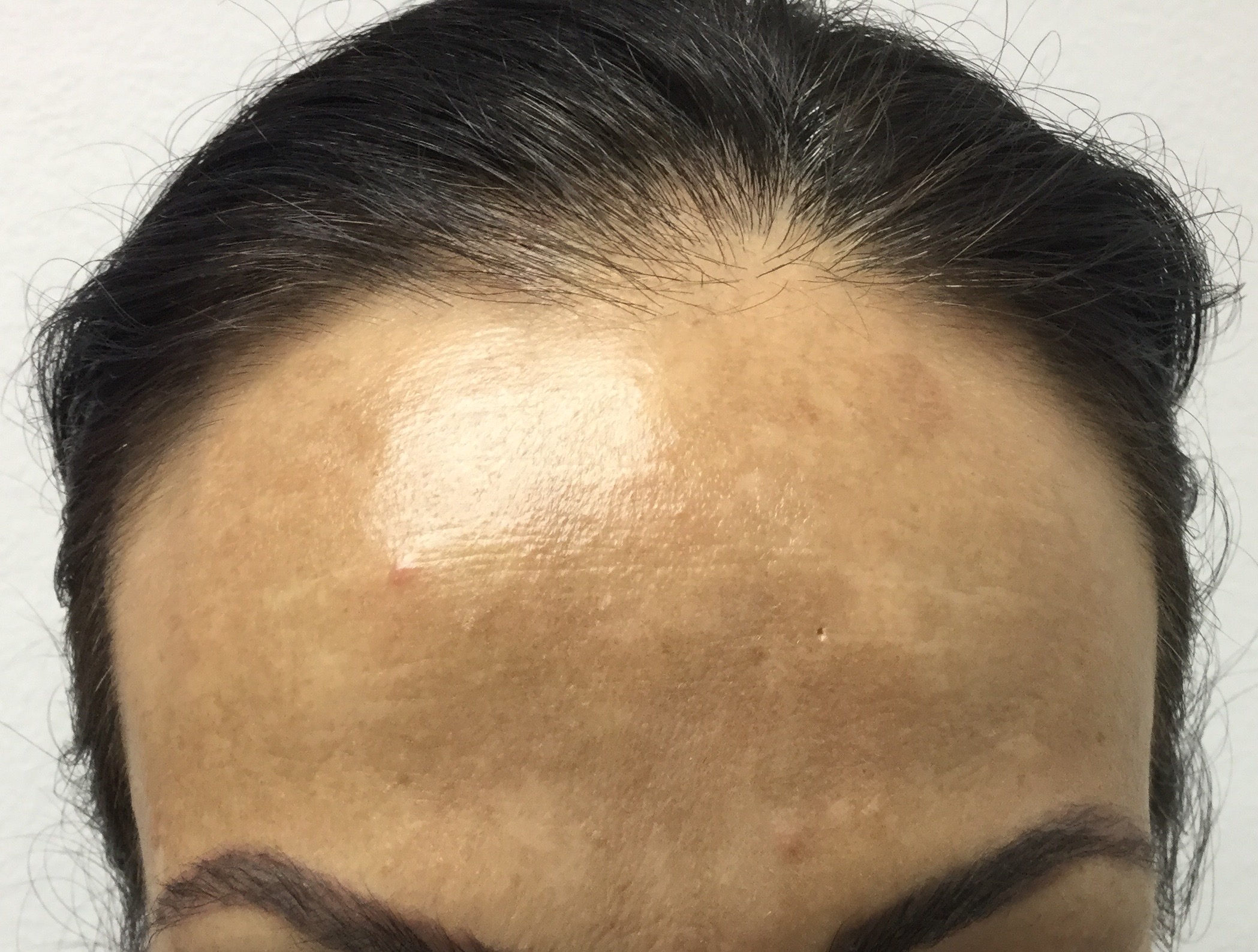 Melasma Adrian Imbernon Derma