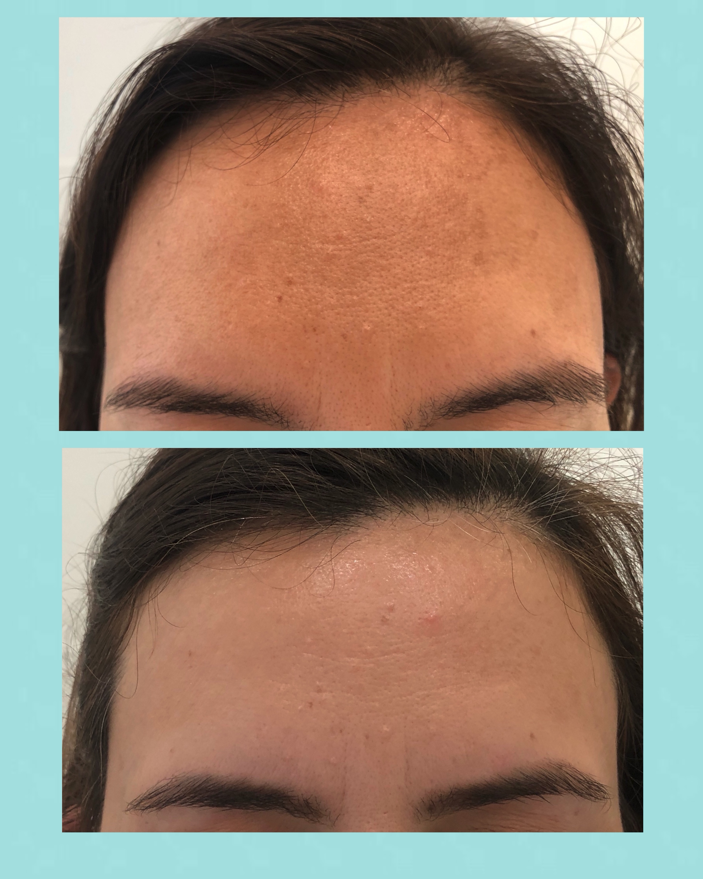 Tratamientos del Melasma