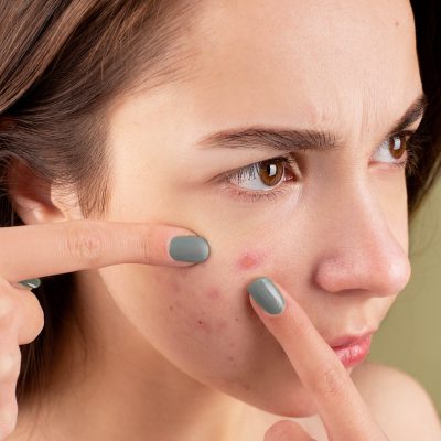 Cicatrices acne factores de riesgo