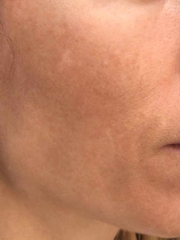 Melasma luminico 1 antes