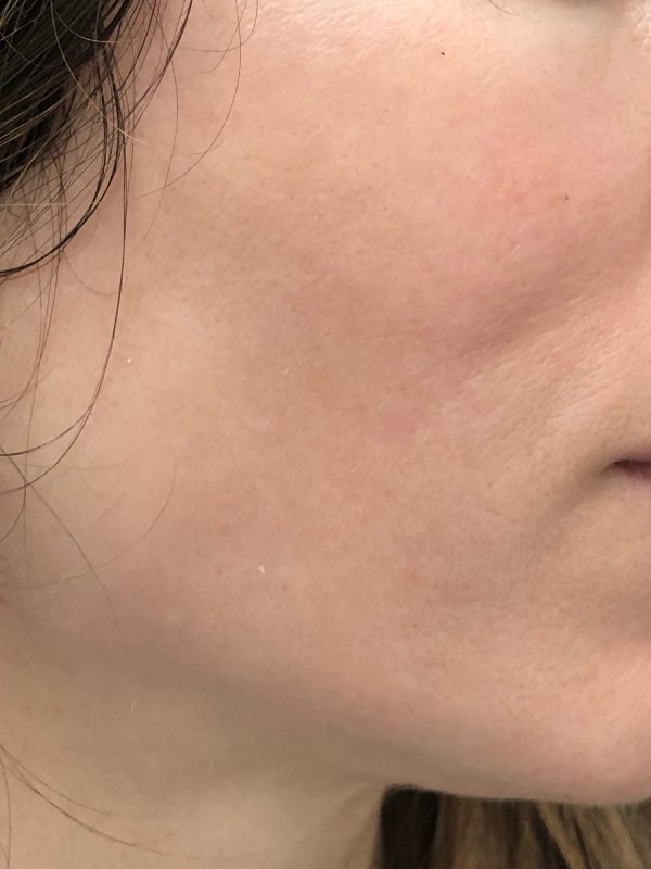 Melasma luminico 1 despuess