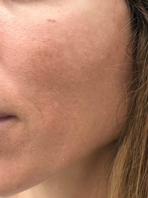 Melasma luminico 2 antes