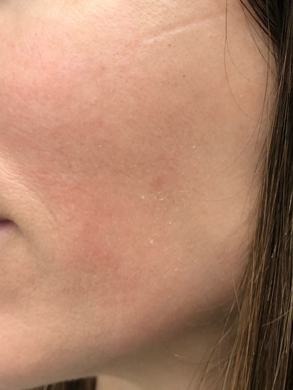 Melasma luminico 2 despues