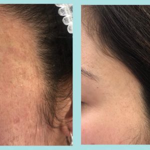 cicatrices acne laser fraccionado ablativo 1