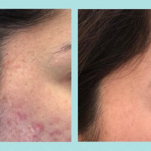 cicatrices acne laser fraccionado ablativo 2